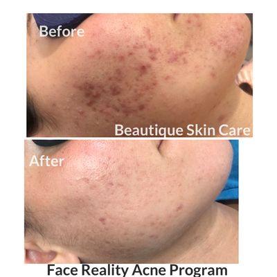 Acne treatment