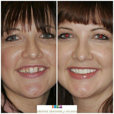 Smile Makeover Results