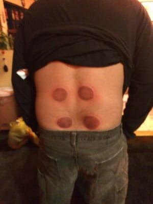 Don't be afraid of the "cupping" it doesn't hurt and is good for you! Although it may leave you with some hickies.