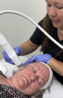 Potenza RF microneedling