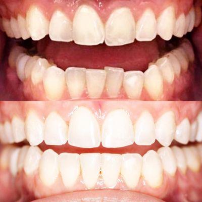 Invisalign Before + After