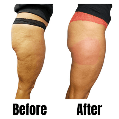 Cellulite removal on the thighs.