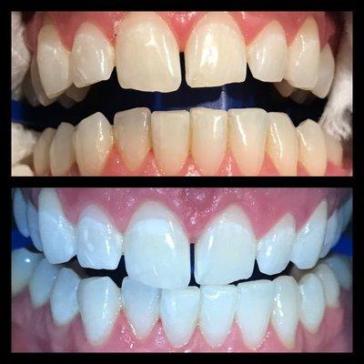 1 hour zoom whitening