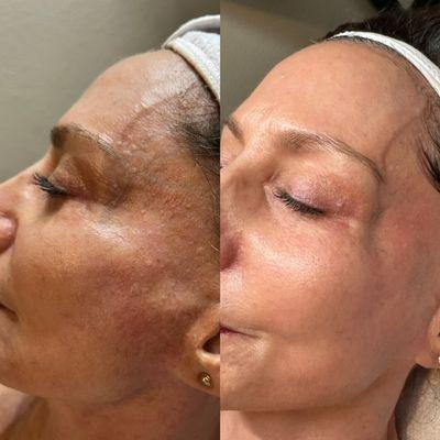 Before & After Microneedling (8 treatments)