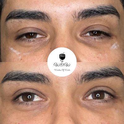 Undereye filler by Warda