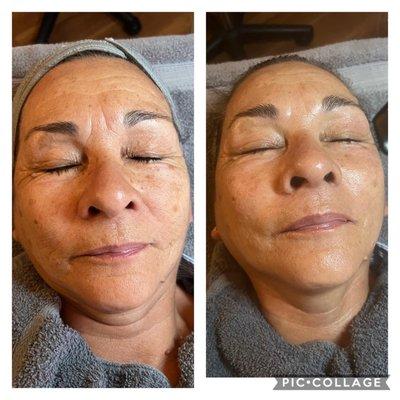 Non Invasive RF face lifts