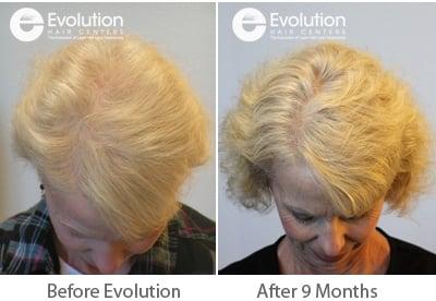 Women's Hair Loss Treatment Results