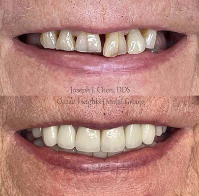 "I never have to think before I smile anymore.  Life changing."

Full mouth rehab over natural teeth and implants.