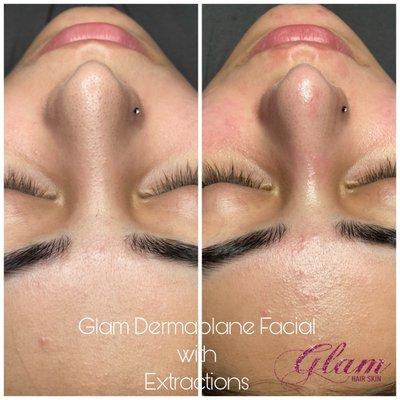 Deep Pore Acne Facial w/extractions Before and After