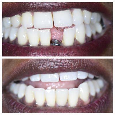 Dental implant before and after done at Plaza Dentistry