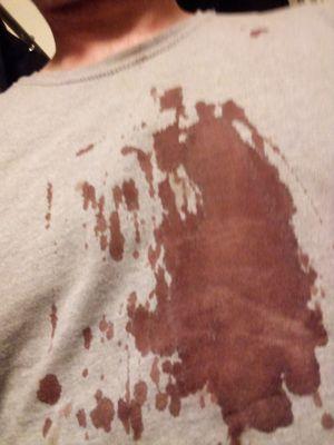 My shirt filled with blood immediately after surgery.