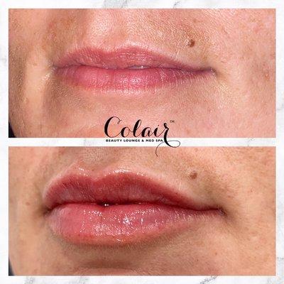 Lip filler at Colair Beauty