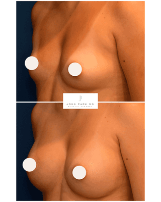 Breast Augmentation with Mentor Silicone Implants, Liposuction of the Axilla