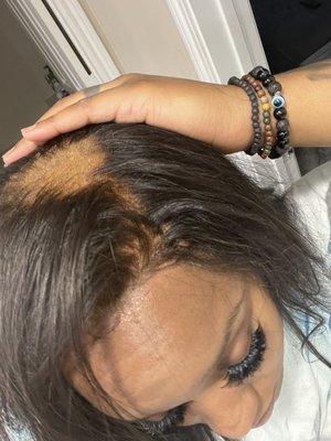 Balding closure  after only a week and a half