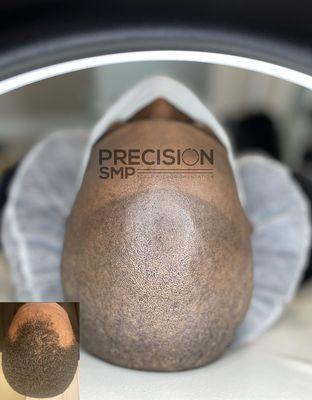 Hairline restoration