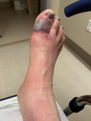 Infected toe