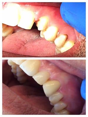 Replace broken tooth with crown