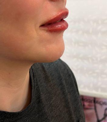 After picture of baby plump lip filler injection with REVANESSE LIPS