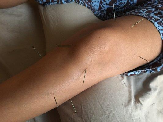 Acupuncture for knee pain.