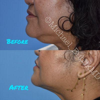 Neck liposuction performed by Dr. Bublik