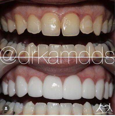 Everything from shade to shape is customized by design. Schedule a consultation with Dr. Kam about your smile makeover.