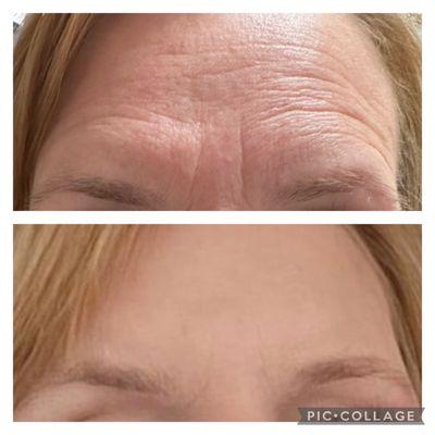 Xeomin a neruo toxin before and after