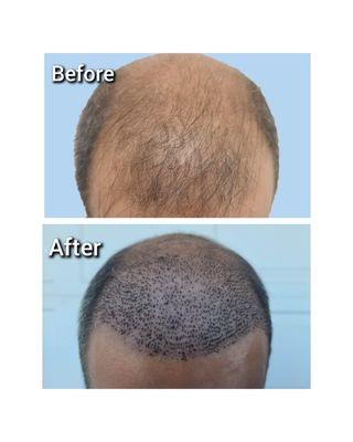 Hair Transplant