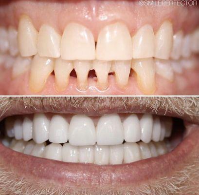 Full mouth restoration... 12 upper & 12 lower Porcelain (full coverage) crowns