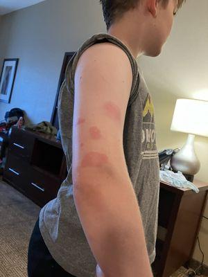 Son's arm covered in flea bites