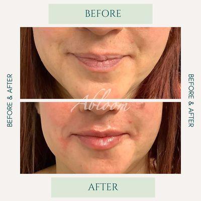 Rejuvenating lips