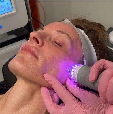 Vybe RF microneedling for collagen stimulation. This device smoothes lines, tightens skin laxity, treats acne scars and more!!