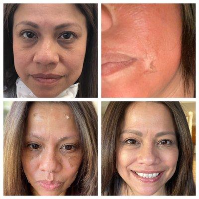 Chemical peel and under eye fillers ... WOW