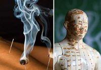 Moxibustion with Acupuncture