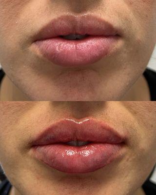 Patient desired more hydration and pout. Goal was achieved with RHA 3. Individual results may vary.