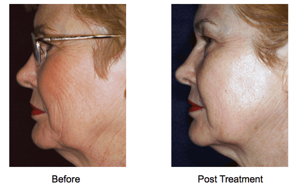 Fine Lines & Skin Tightening Before and After