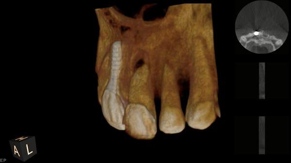 First view of a Cone Beam 3-D image of failing Implant with an apical lesion on adjacent tooth #9