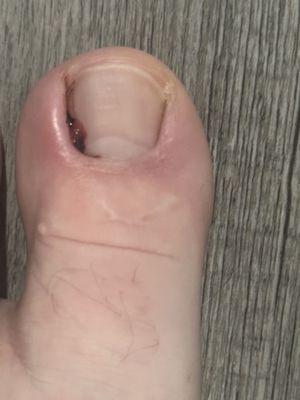 My bloody toe.