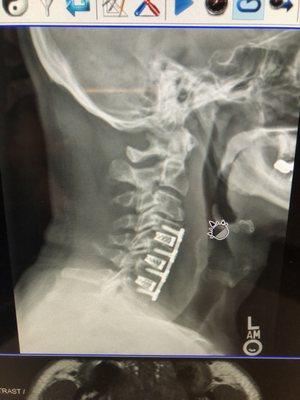 Multi-Level ACDF of my actual cervical spine.  Nice work Dr. Athanassious !