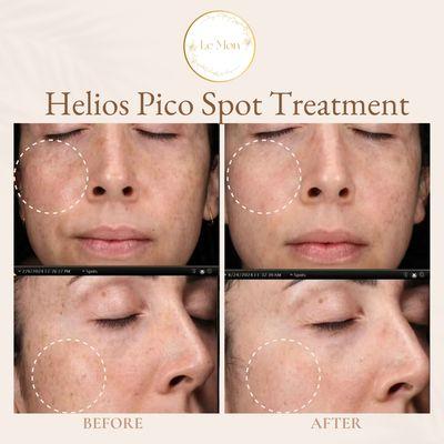 2 Sessions Of Helios Pico Spot Treatment