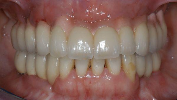 Full mouth reconstruction over implants