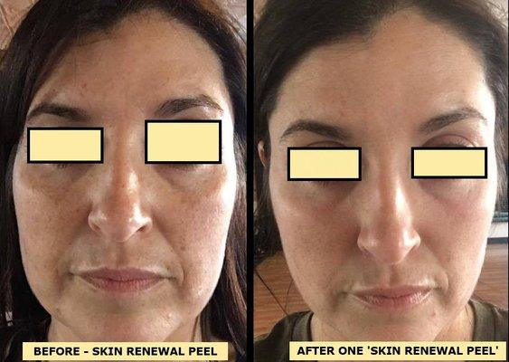 BEFORE AND AFTER ONE SKIN RENEWAL PEEL