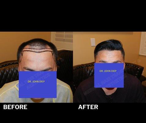 MENS FRONTAL HAIR LOSS BEFORE & AFTER PHOTO