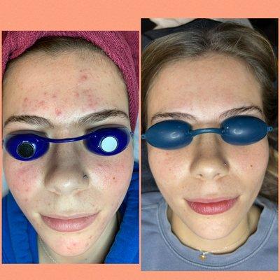 Fantastic Acne Clinic results