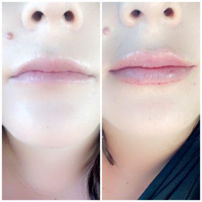 Lips before and right after