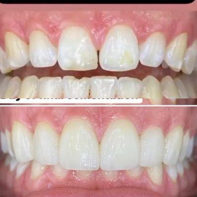 Before and after- 6 veneers on front 6 teeth