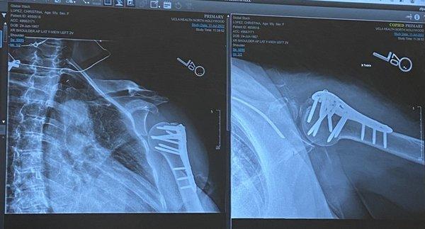 After and before X-ray views: broken humerus, dislocated and severe damage to deltoid muscle and auxiliary nerves