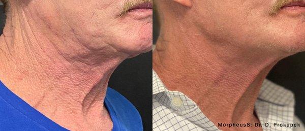 Neck TX of Morpheus 8. Before and After.