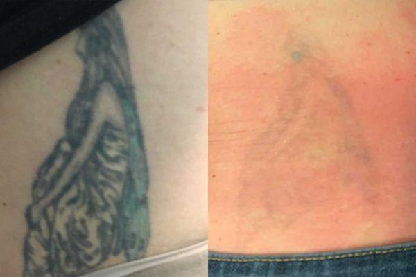 TakeTatt Tattoo Removal