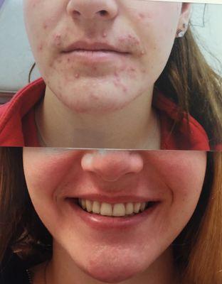 A tailored acne treatment consistent of topical and oral medications