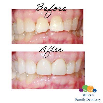 Chipped a tooth or two? Ask us how we can use crown and bridge technology to restore your smile!